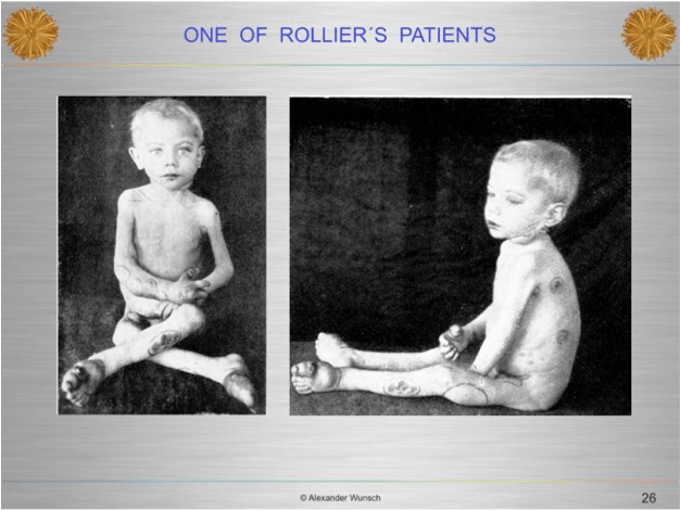 Rolier rickets patient