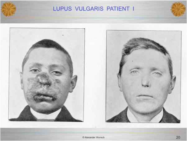 lupis patient 1