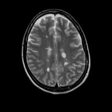 MRI brain