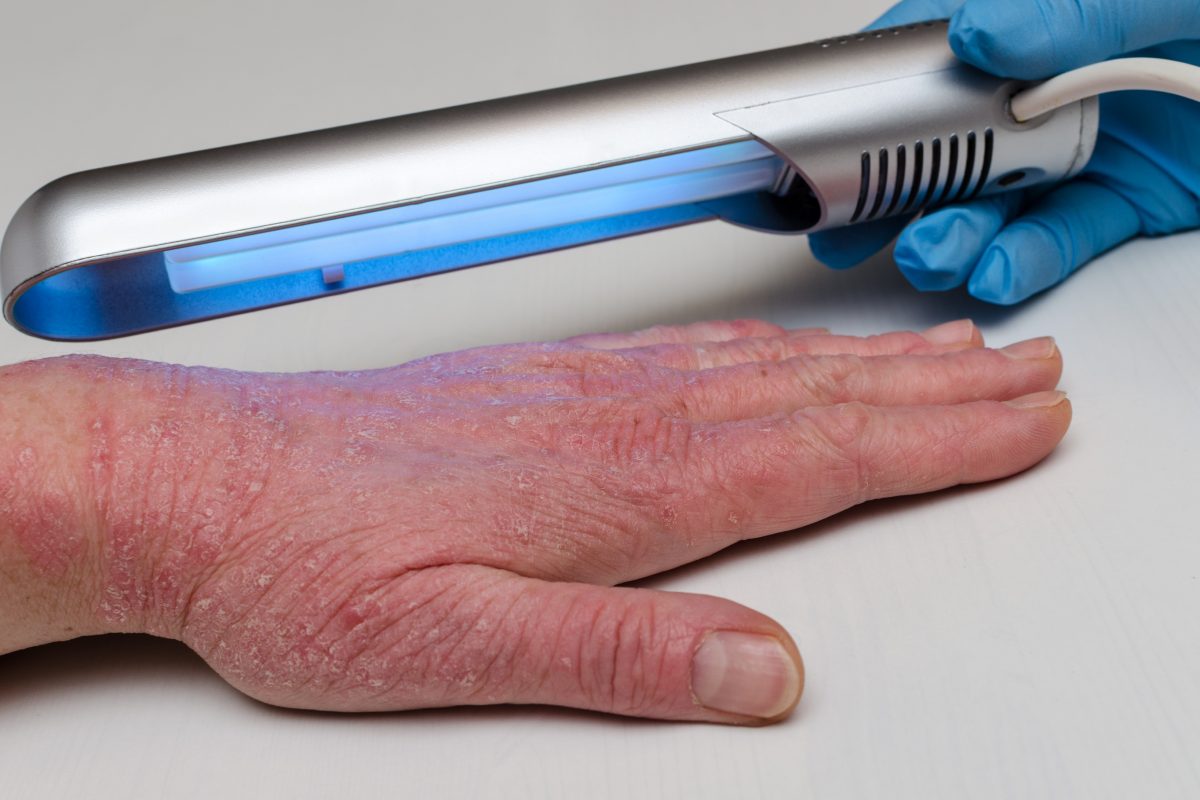 Phototherapy Helps Improve Symptoms in Skin Disorders  GrassrootsHealth